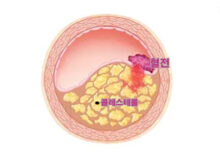 콜레스테롤 수치 낮추는음식 - 동맥경화 혈관