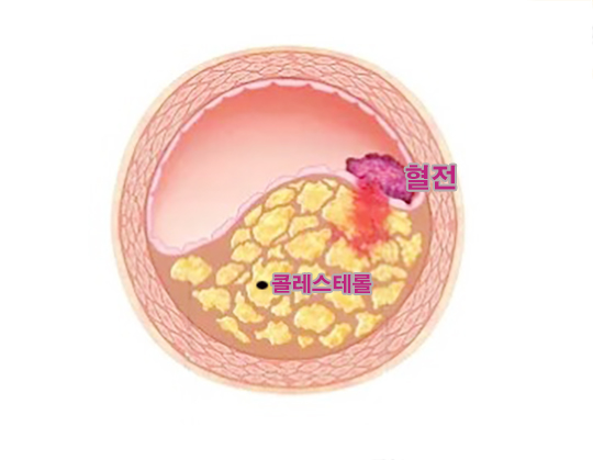 콜레스테롤 수치 낮추는음식 - 동맥경화 혈관