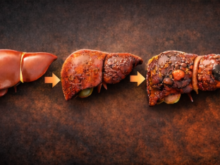 초기 간암 증상 - 음주 및 기타 질환으로 인한 간 손상