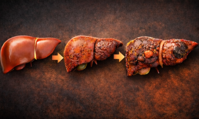 초기 간암 증상 - 음주 및 기타 질환으로 인한 간 손상